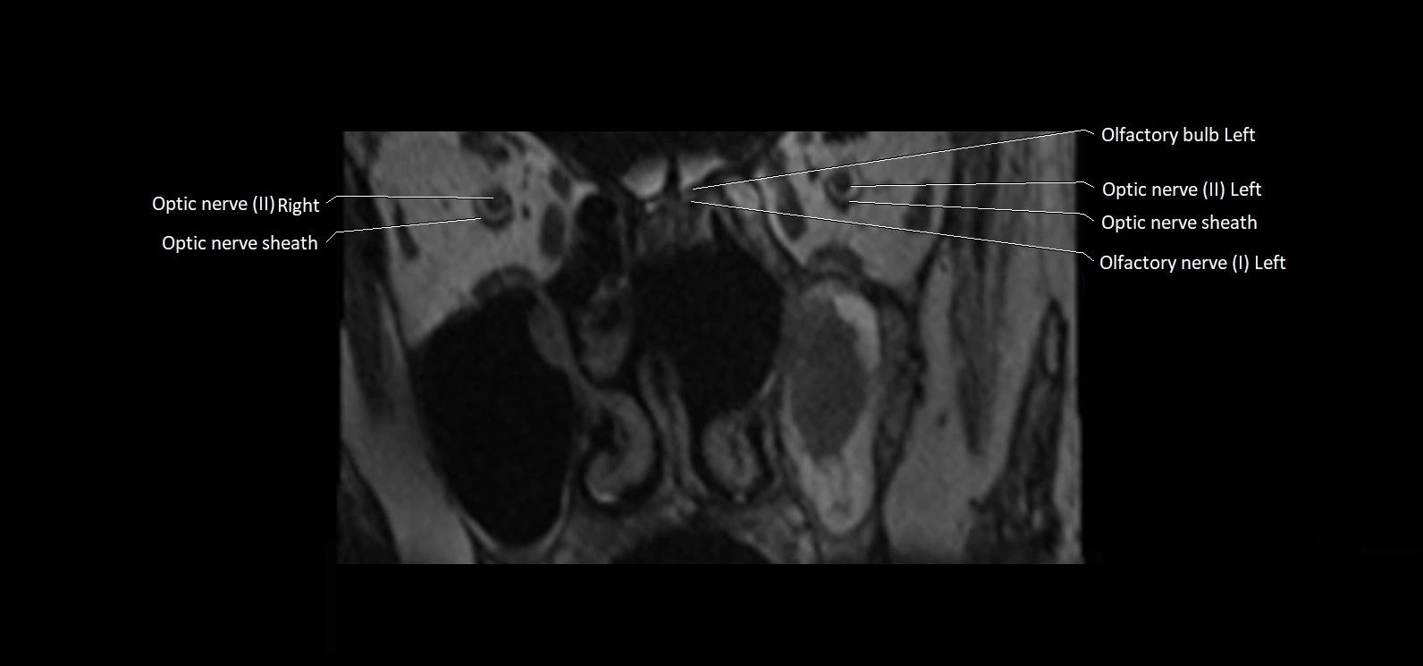 Cranial nerve cross sectional anatomy coronal 3T MRI image 3.webp